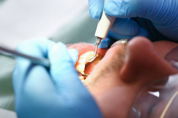 Best Emergency Root Canal Treatment in Hillsdale, MI